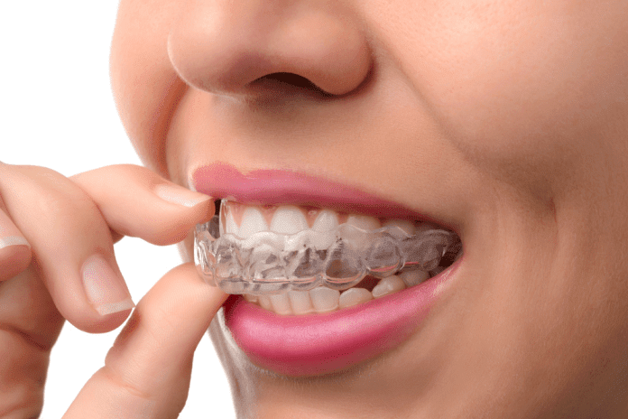 Potential Benefits Of Using Clear Aligners